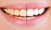 Chuyên gia mách bạn bí quyết giúp răng luôn trắng sáng tự nhiên như đi nha sĩ