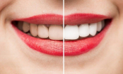 5 cách giúp đánh bay vết ố vàng trên răng ngay tại nhà, hiệu quả không kém gì tẩy trắng