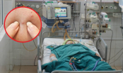 Cô gái 19 tuổi bị nhiễm trùng nội sọ vì nặn mụn: Cảnh báo vùng “tam giác tử thần” không được động chạm