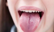 Nhà khoa học chỉ rõ: Dấu hiệu nhận biết COVID-19 qua lưỡi