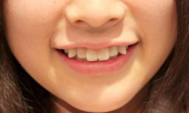 Phụ nữ sở hữu 3 tướng răng này chứng tỏ số khổ, hay gặp thị phi