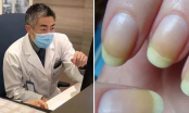 Nhiều người bị tiểu đường mà không biết: Bác sĩ mách cách nhìn vào móng tay để tự phát hiện