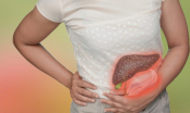 2 dấu hiệu ở bụng cảnh báo bệnh gan nguy hiểm, bỏ qua là hối hận không kịp