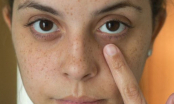 3 biểu hiện trên khuôn mặt nữ giới ngầm cảnh báo tử cung đang có vấn đề