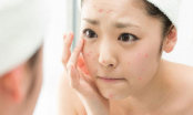 6 vấn đề da hay gặp vào mùa đông, bạn cần chú ý để chăm sóc da tốt nhất