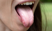 Lưỡi có 1 trong 5 biểu hiện sau là dấu hiệu của bệnh: Thấy lưỡi chuyển vàng, tím phải coi chừng