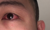 Chuyên gia cảnh báo: F0 mắc Covid-19 thấy dấu hiệu này ở mắt cần đi khám gấp, cẩn thận mù vĩnh viễn