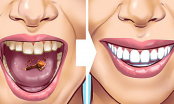7 cách đơn giản giúp loại bỏ cao răng tại nhà mà không hề tốn kém