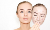 5 loại mặt nạ dành cho da hỗn hợp dưỡng ẩm, kiểm soát dầu và trẻ hóa làn da