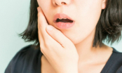 10 cách giảm đau khi mọc răng khôn tại nhà: Nhanh mà hiệu quả
