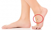 3 nốt ruồi ở lòng bàn chân tượng trưng cho Tài - Lộc  - Danh ai có 1/3 cũng viên mãn trọn đời