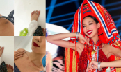 Á hậu Bảo Ngọc gây lo lắng khi bị bầm dập khắp nơi trên cơ thể trước thềm Chung kết Miss Intercontinental