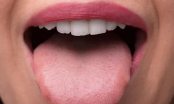 Lưỡi là thước đo sức khỏe: Nếu 4 thay đổi này không xuất hiện thì chứng tỏ sức khỏe bạn đang rất ổn định