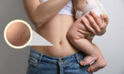6 mẹo khắc phục tình trạng rạn da sau sinh giúp chị em lấy lại vẻ căng mịn cho làn da