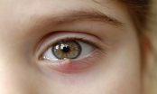 Bật mí 8 cách chữa lẹo mắt đơn giản tại nhà, không nên bỏ qua