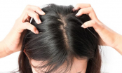 4 tác hại khôn lường với da đầu nếu bạn quên gội đầu sau mỗi lần tập luyện