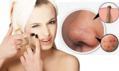 5 mẹo trị mụn đầu đen ở mũi, giúp thu nhỏ lỗ chân lông trong thời gian ngắn