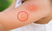 Mẹo giảm ngứa tức thì khi bị muỗi đốt, an toàn với cả trẻ nhỏ