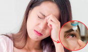 4 cách chữa đau mắt đỏ tại nhà đơn giản, hiệu quả nhanh chóng