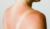 Các cấp độ da cháy nắng và thời gian phục hồi an toàn cho làn da bạn nên biết