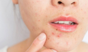 Nguyên nhân gây suy giảm sức khỏe làn da và loạt mẹo phục hồi làn da xấu xí