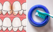 5 cách  lấy cao răng siêu đơn giản tại nhà, không tốn xu nào