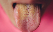 Nếu kiểm tra lưỡi có màu vàng, hãy cẩn trọng với 5 bệnh này