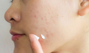 9 công thức đơn giản chăm sóc làn da bị thâm, giảm sẹo mụn hiệu quả