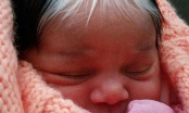 Kỳ lạ: Em bé sinh ra có 2 màu tóc, 2 màu da và vết bớt trắng đặc biệt