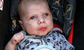 Phẫn nộ: Bé trai 9 tuần tuổi bị bố đẻ đánh đập gãy xương, chảy máu trong não ch.ết thương tâm