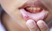 Những dấu hiệu cảnh báo ung thư miệng bạn không nên bỏ qua