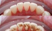 Sạch cao răng vĩnh viễn không cần đi nha sỹ chỉ trong 3 phút