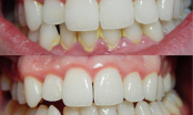 Răng trắng bóc chỉ trong 1 phút cả đời không cần lấy cao răng