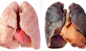 Thực phẩm giúp lọc sạch phổi cho người hút thuốc lá