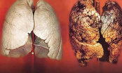 4 loại quả ăn vào lọc sạch phổi cho người hút thuốc lá