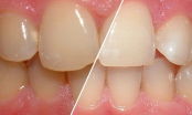 Các cách loại bỏ cao răng hiệu quả mà bạn nên biết
