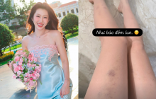 Thúy Ngân đăng tải bức ảnh cận cảnh đôi chân với nhiều vết thương