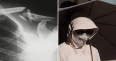 Một phụ nữ bị gãy xương do thói quen che nắng cẩn thận quá mức