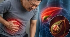 3 dấu hiệu cảnh báo viêm túi mật nặng