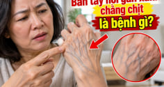Bàn tay nổi gân xanh chằng chịt là bệnh gì?