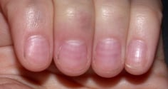Nhìn móng tay bắt bệnh cực kỳ chính xác
