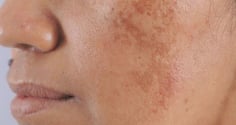 Bạn bị đốm đồi mồi, tàn nhang thường là do 3 điều này, hãy chủ ý đển chúng để có làn da đẹp