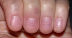 Nhìn móng tay bắt bệnh cực chuẩn