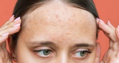 Nhận diện sẹo rỗ và 5 phương pháp cải thiện giúp làn da dần mịn màng hơn