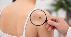  5 dấu hiệu bất thường trên da có thể cảnh báo nguy cơ ung thư: đừng chủ quan
