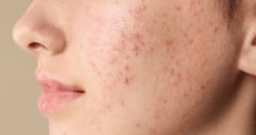 5 cách giúp giảm mụn cám tại nhà, hỗ trợ da thông thoáng và mịn màng hơn