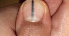 5 dấu hiệu trên móng tay cảnh báo bệnh nan y: Có 1 trong 5 dấu hiệu cũng nên đi khám gấp