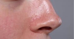 Da dầu mụn có cần dưỡng ẩm không? Nhiều người đang mắc sai lầm khiến mụn ngày càng nghiêm trọng