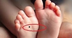 4 nốt ruồi trên chân mang tới may mắn cho bạn: Ai có thật đáng chúc mừng