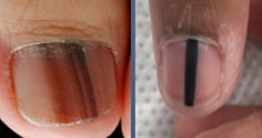 Cảnh báo từ Bác sĩ Da liễu Trung ương: 5 dấu hiệu trên móng tay có thể là 'án tử' ung thư ác tính